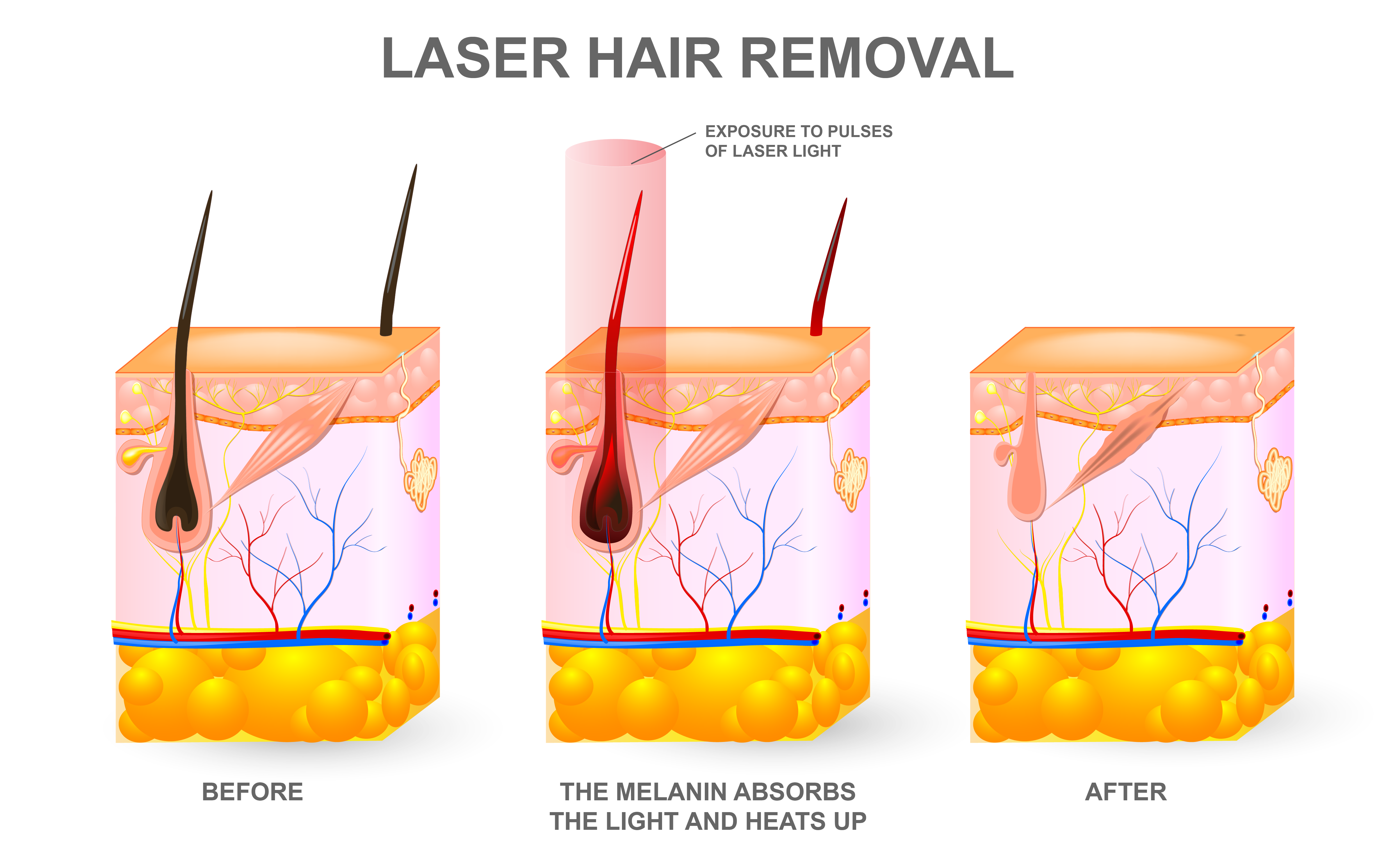 laser hair removal diagram