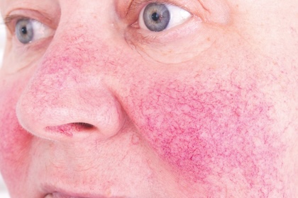 example of rosacea on face