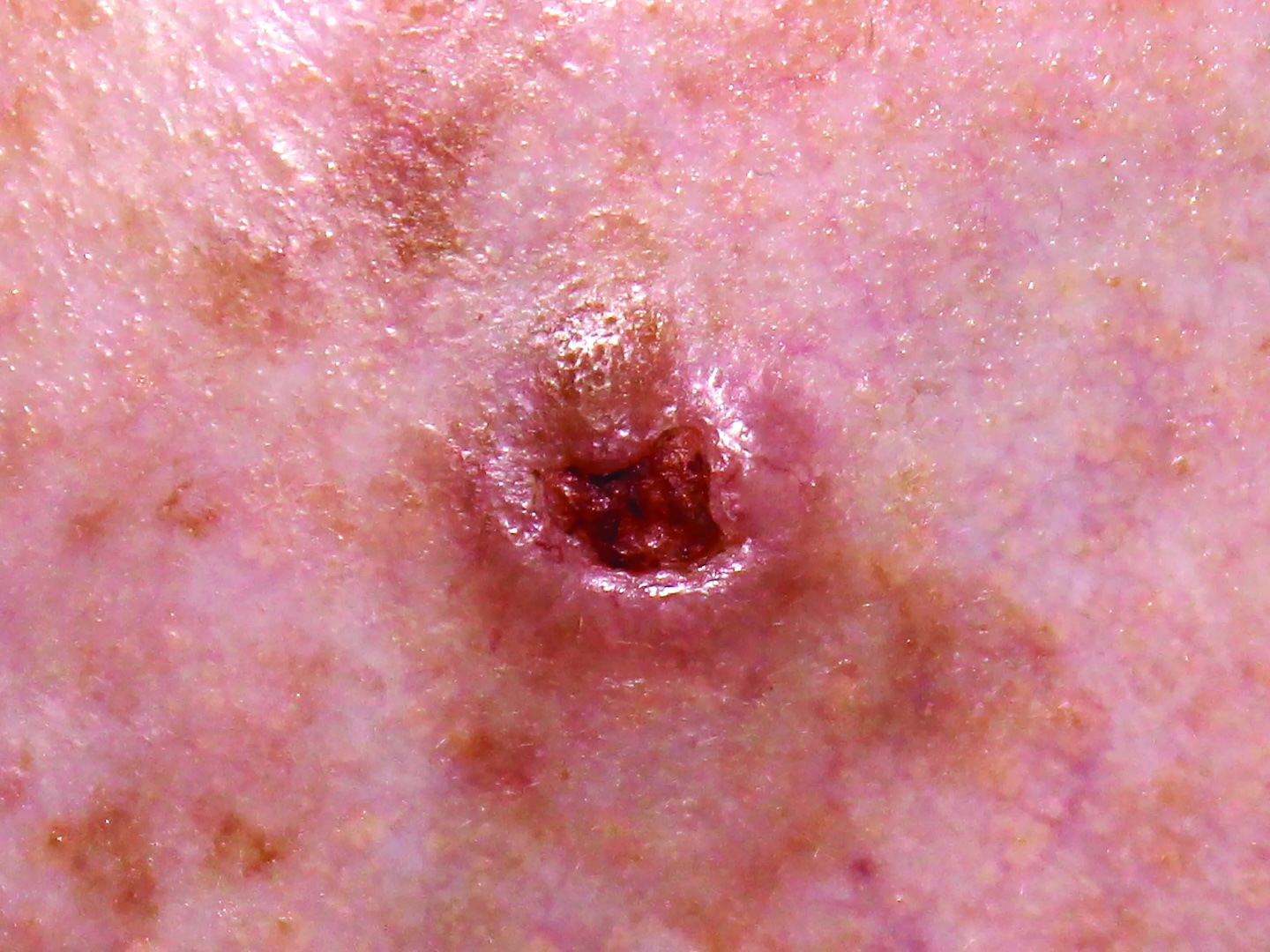 example of basal cell carcinoma