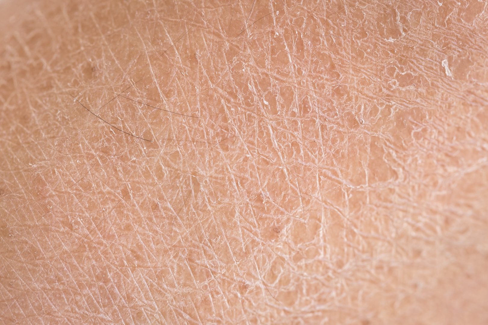 extreme closeup example of dry skin