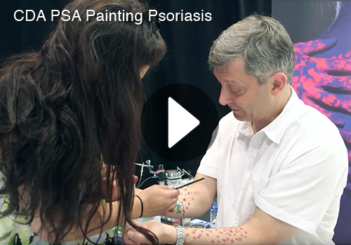 Painting Psoriasis video PSA