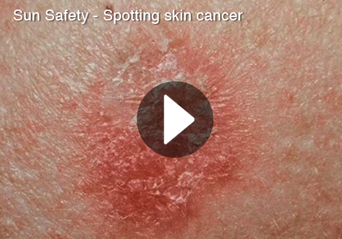 Sun Safety: Spotting Skin Cancer video