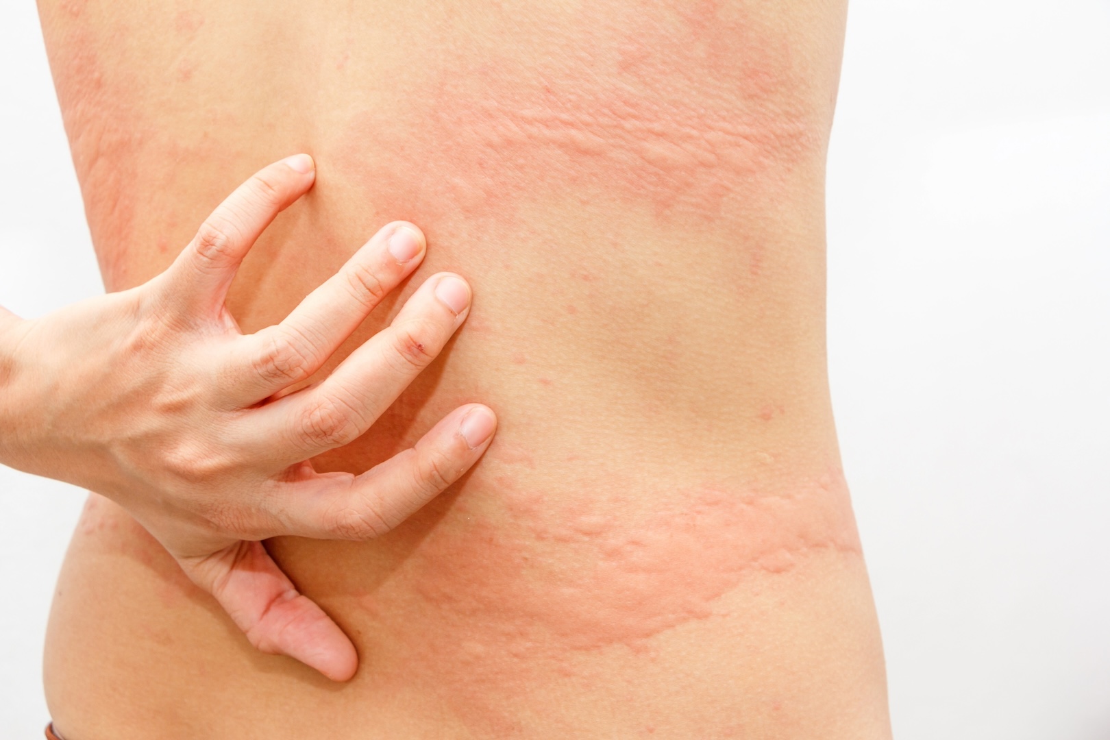 example of urticaria as seen on a woman's back