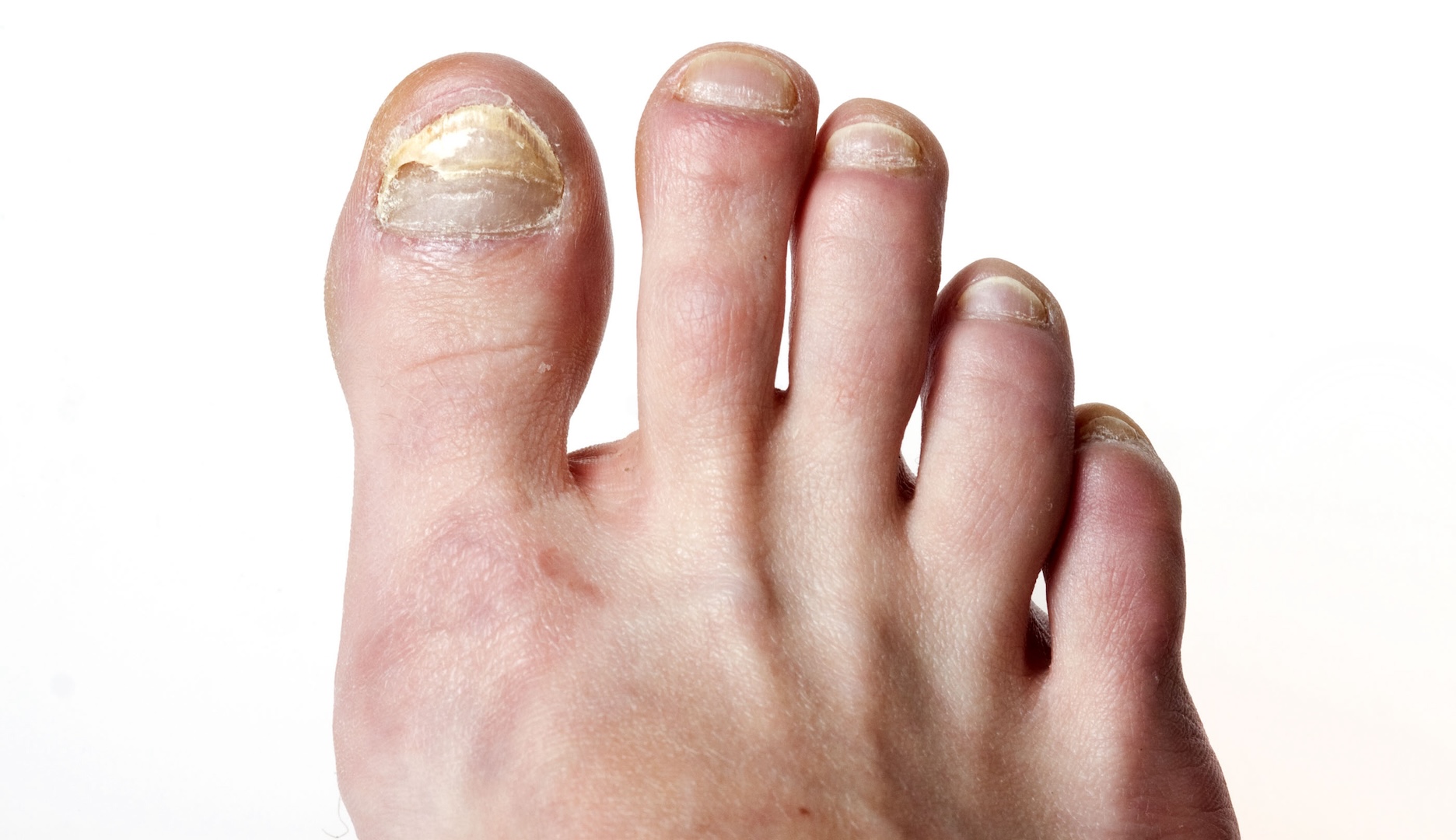 example of a nail infection
