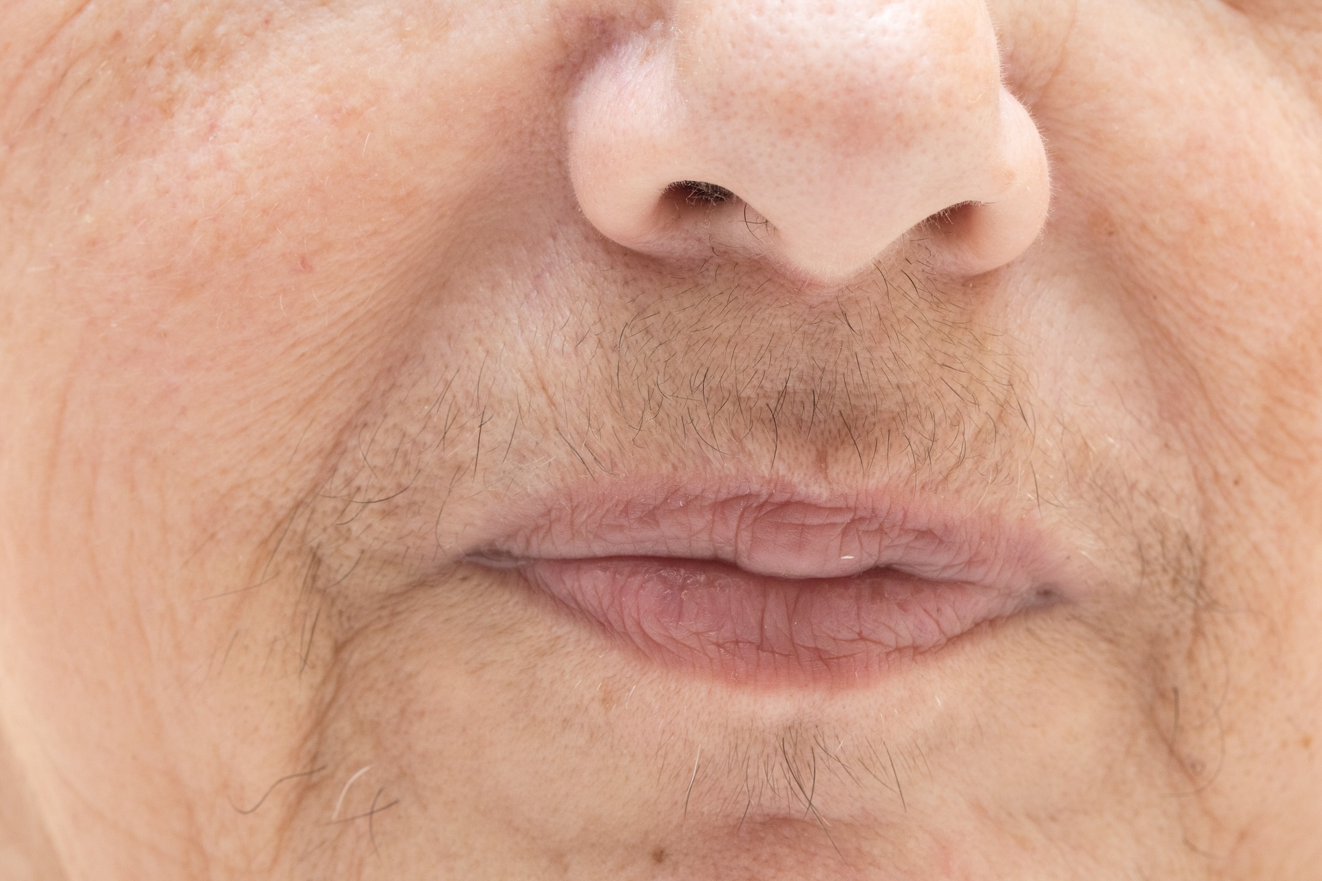 example of hirsutism