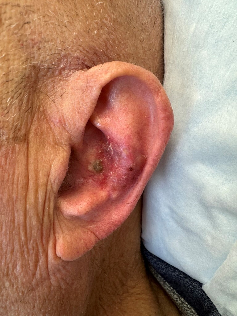 closeup of ear displaying signs of squamous cell carcinoma