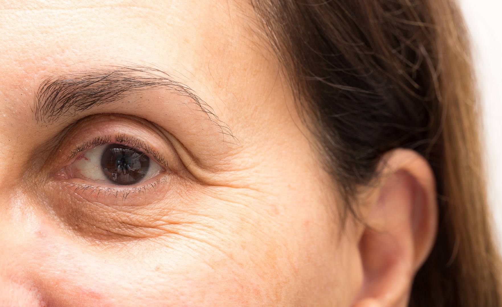 example of photoaging around the eye