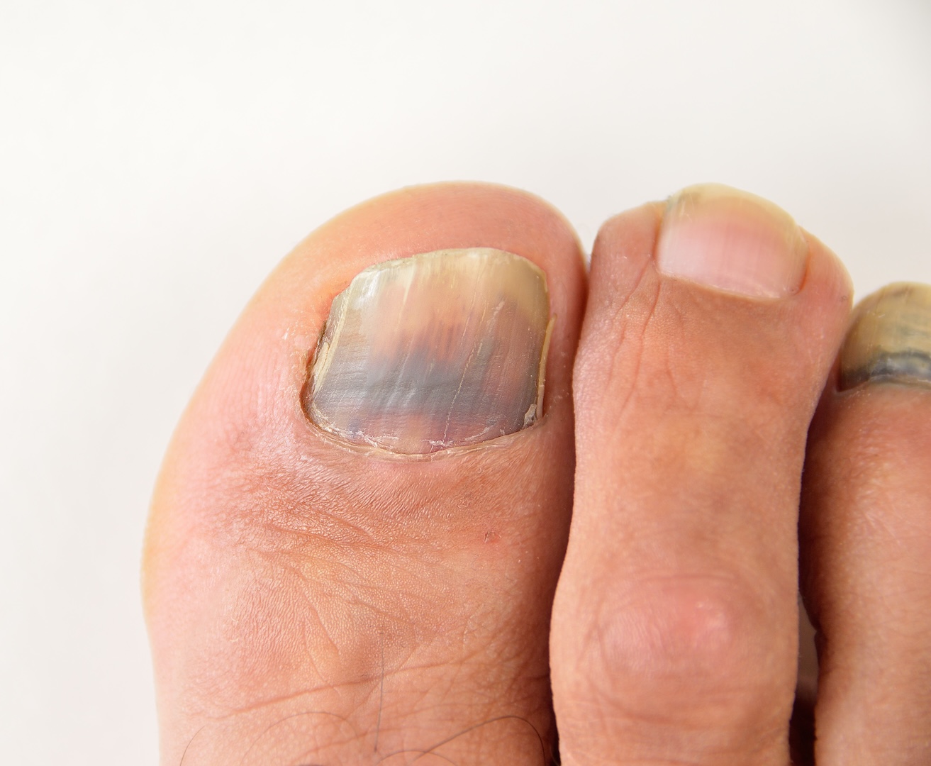 example of subungual melanoma of the toenail