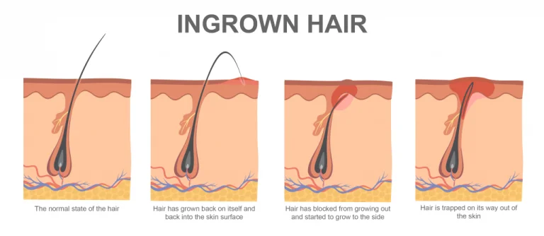 diagram showing various states of ingrown hair growth