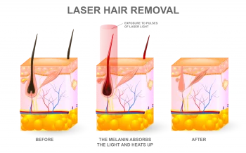 diagram detailing before and after effects of laser hair removal