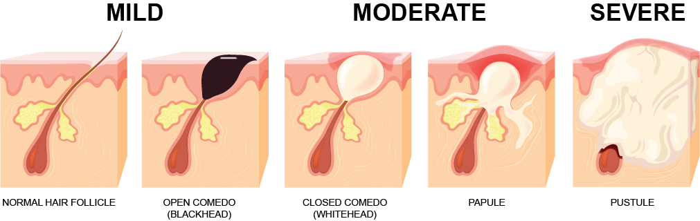 Stages of Acne